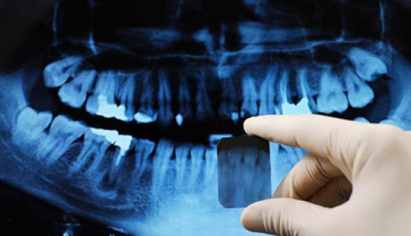 5کاربرد عکس رادیوگرافی در دندان‌پزشکی